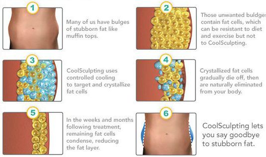 procedură pentru a elimina celulele grase)